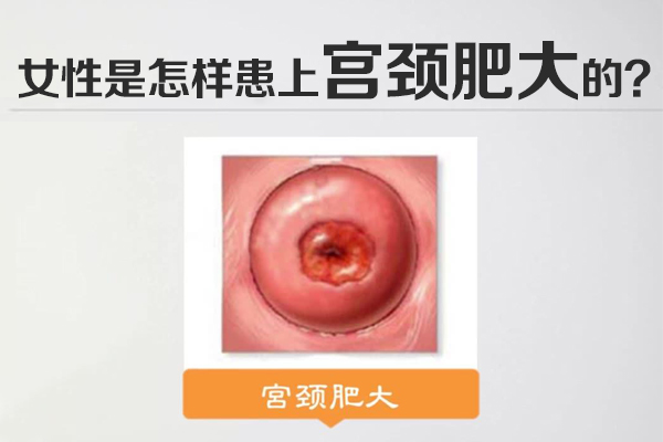 女性是怎样患上宫颈肥大的(图1)